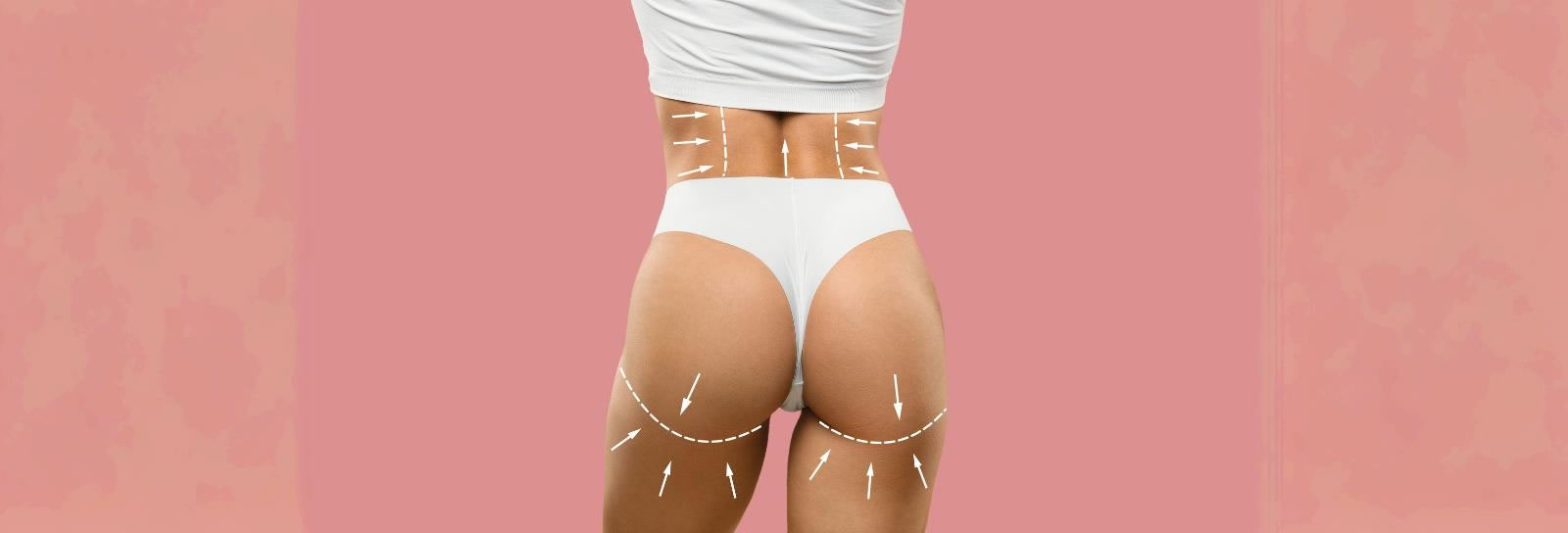 Gluteoplasty